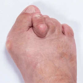 Bunion Splint: Relief and Support for Bunion Pain and Alignment