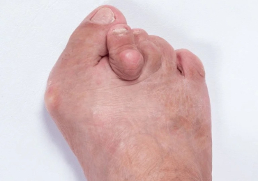 Bunion Splint: Relief and Support for Bunion Pain and Alignment
